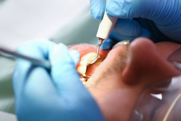 Best Emergency Tooth Extraction in Perry, KS