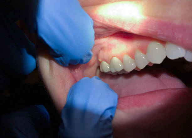 Best Emergency Denture Repair in Perry, KS