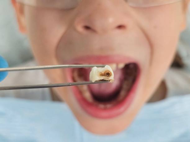 Best After-Hours Dental Trauma Care in Perry, KS