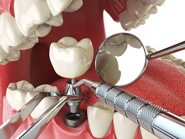 Best Emergency Wisdom Teeth Removal in Perry, KS